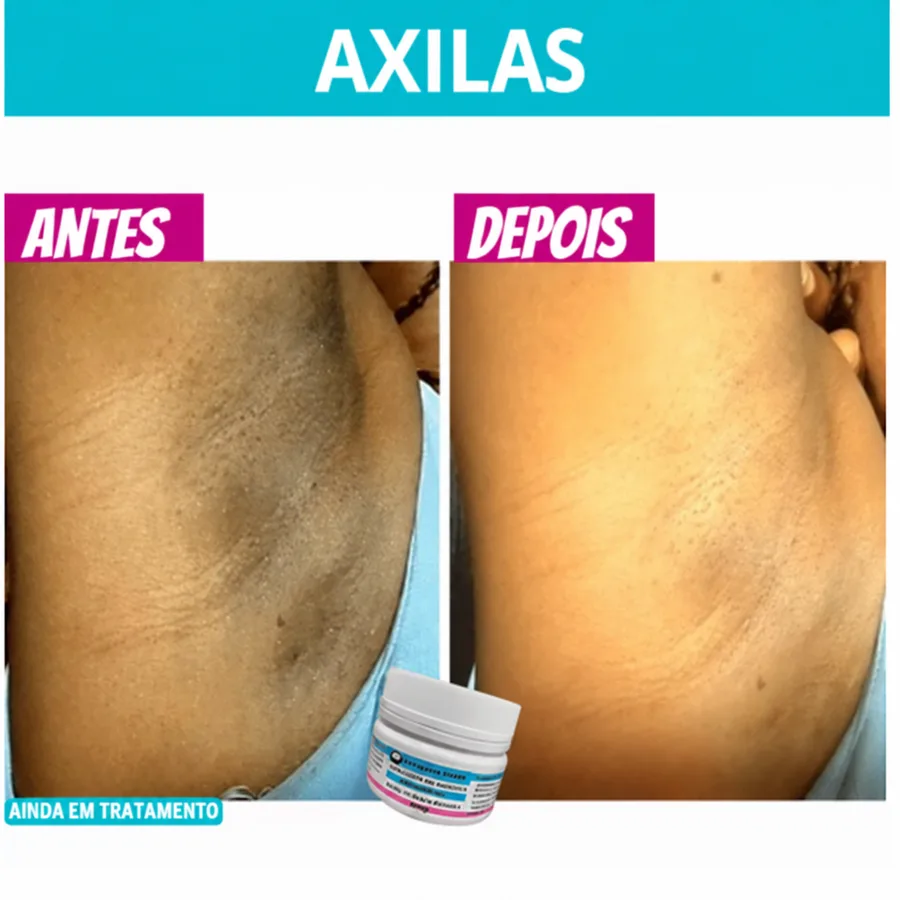 Resultado real com Amazolé clareador esfoliante