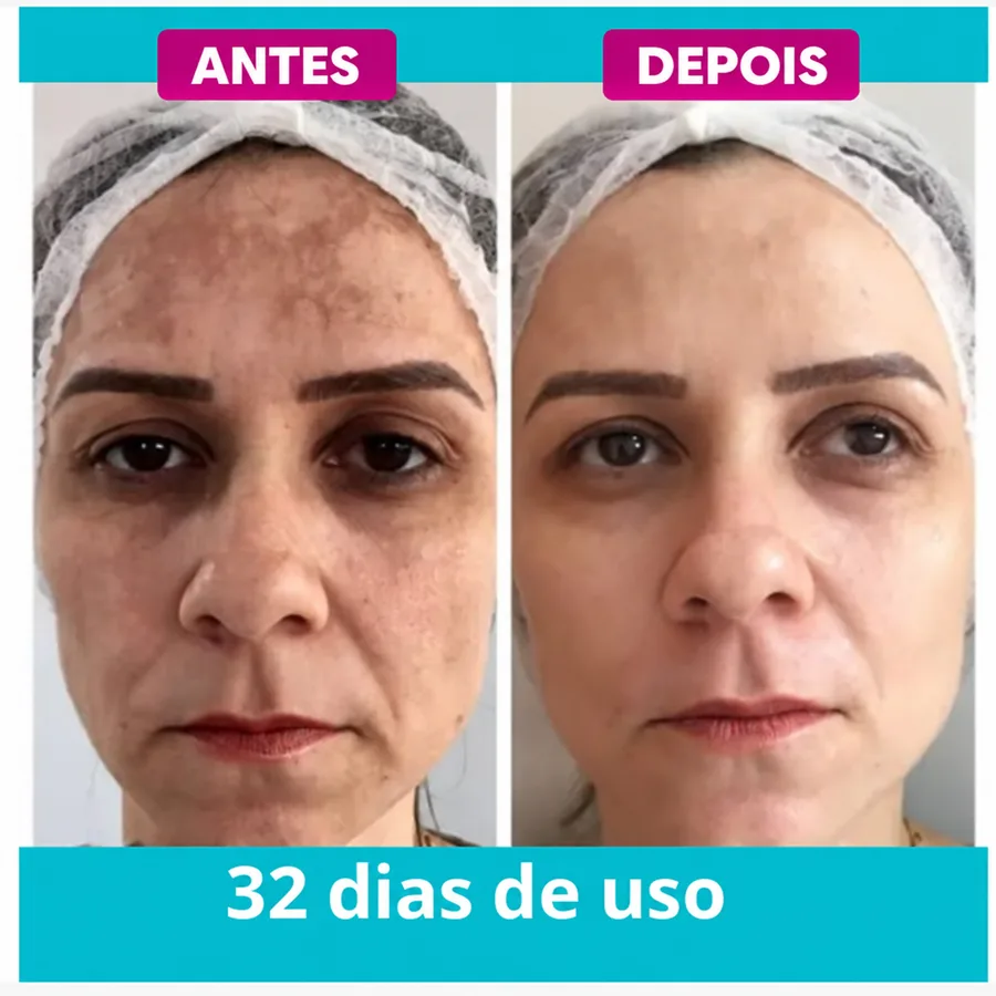 Antes e depois com Amazolé